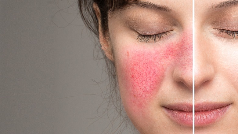 skincare ingredients to avoid with rosacea